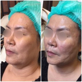Before and after thread lifting at ASIA CLINIC, facial contour improvement result
