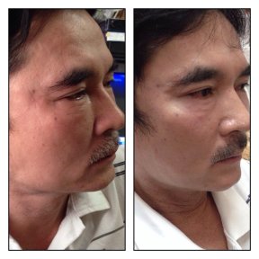 Before and after threads lifting results at ASIA CLINIC, facial skin tightening procedure