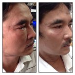Before and after threads lifting results at ASIA CLINIC, facial skin tightening procedure