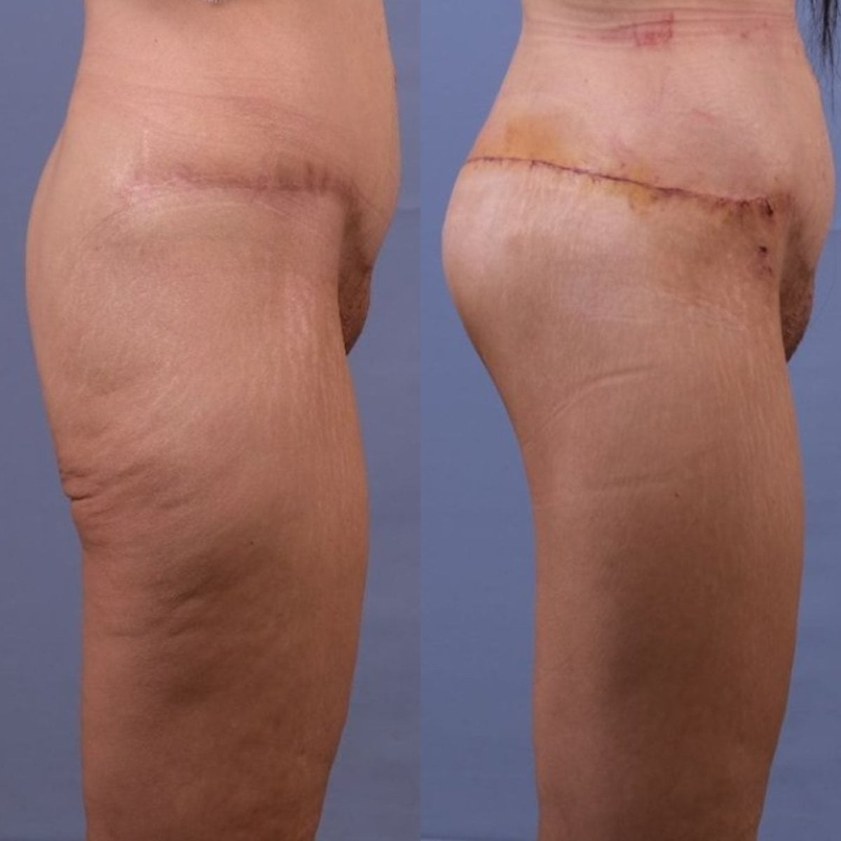 Resultados antes y después de lifting corporal inferior en Dr. Safa Manav Clinic, mejor contorno