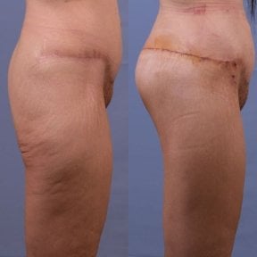 before-after photo lower-body-lift