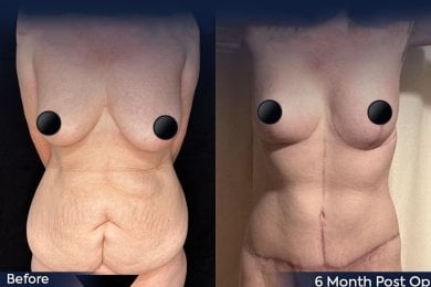 before-after photo lower-body-lift