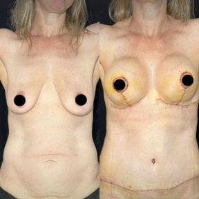before-after photo lower-body-lift