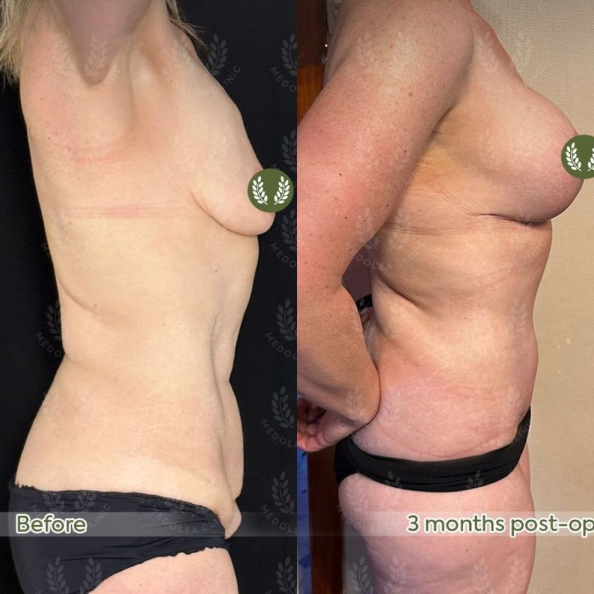 Resultados antes y después de lifting corporal inferior en Dr. Safa Manav Clinic, mejor contorno