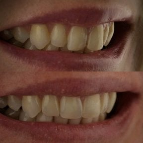 before-after photo dental-bonding