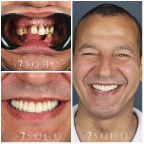 Результат до та після імплантації All-on-4 у Soho Clinic – повне відновлення усмішки