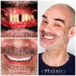 Результат до та після імплантації All-on-6 у Soho Dental Clinic, повне відновлення усмішки