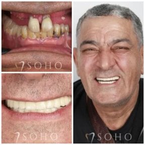 Результат до та після імплантації All-on-6 у Soho Clinic – відновлення посмішки