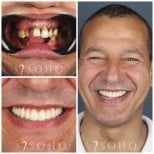 Результат до та після імплантації All-on-6 у Soho Clinic – повне відновлення усмішки
