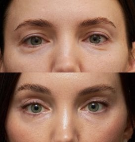 Before and after brow lift results at Vidnova Clinic – lifted brows and refreshed eye area
