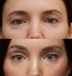 Before and after brow lift results at Vidnova Clinic – lifted brows and refreshed eye area