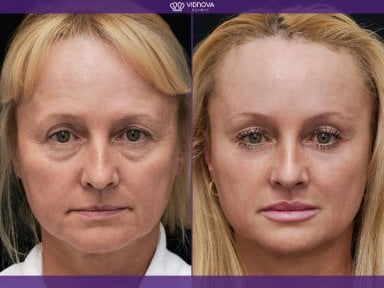 Resultados de lifting de cejas antes y después en Vidnova Clinic – rejuvenecimiento visible