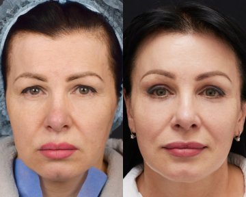 Efekty przed i po liftingu brwi w Vidnova Clinic – odmłodzona okolica oczu i czoła