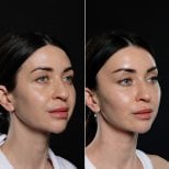 Before and after brow lift results at Vidnova Clinic – visible eyebrow lift and rejuvenation