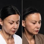 Before and after brow lift results at Vidnova Clinic – visible forehead and brow rejuvenation