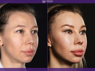 Результат до та після deep plane SMAS підтяжки у Vidnova Clinic, помітне омолодження обличчя