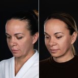 Результати до і після deep plane SMAS-ліфтингу у Vidnova Clinic – омолодження обличчя
