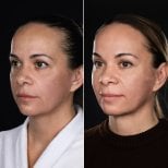 Результаты до и после Deep Plane Facelift в клинике Vidnova, видимое омоложение лица