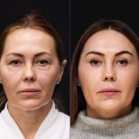 Результати до і після deep plane SMAS підтяжки у Vidnova Clinic – омолодження обличчя
