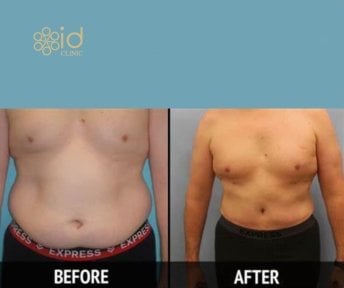 before-after photo abdominoplastika-i-liposakcia