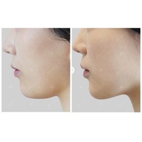 Ultherapy Vorher-Nachher-Ergebnis – sichtbare Kieferstraffung und Hautlifting