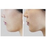 Ultherapy Vorher-Nachher-Ergebnis – sichtbare Kieferstraffung und Hautlifting