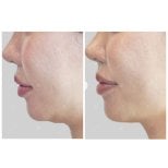 Vorher-nachher-Ergebnis Ultherapy – sichtbare Straffung von Kinn und Kieferlinie