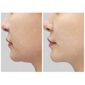 Результаты до и после Ultherapy – видимый лифтинг и подтяжка кожи подбородка