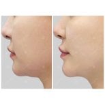 Результаты до и после Ultherapy – видимый лифтинг и подтяжка кожи подбородка
