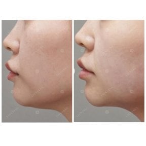 Vorher-nachher-Ergebnis Ultherapy in der Lienjang Klinik – sichtbare Kinnstraffung