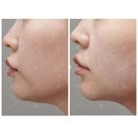 Vorher-nachher-Ergebnis Ultherapy in der Lienjang Klinik – sichtbare Kinnstraffung