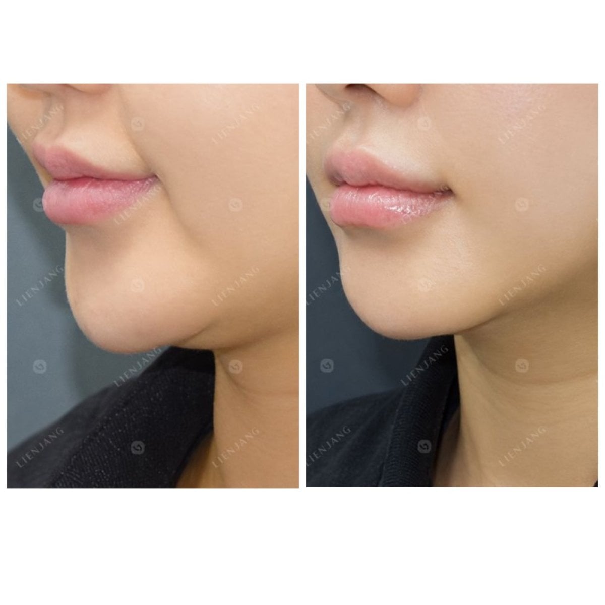 نتائج قبل وبعد علاج Ultherapy في عيادة Lienjang – تحسين تحديد الذقن والفك