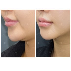 Vorher-nachher-Ergebnis Ultherapy bei Lienjang Clinic – verbesserte Kinnkontur