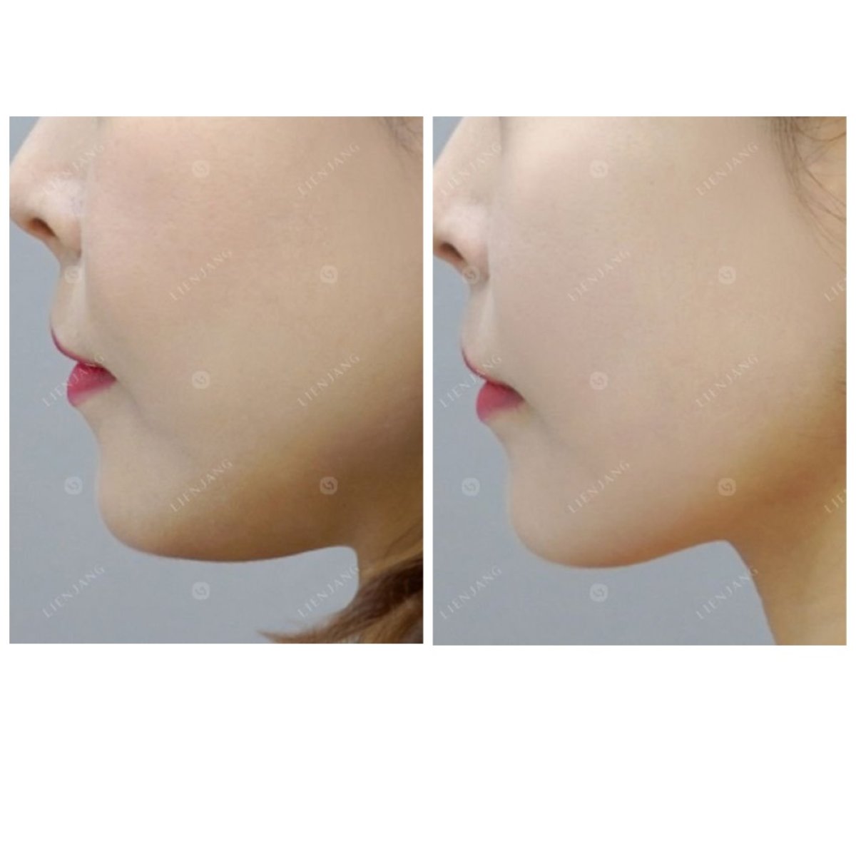 Resultados antes y después de Thermage en clínica: reafirmación y mejora del contorno mandibular