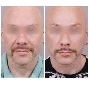 Результаты подтяжки лба до и после у мужчины – более гладкий, приподнятый лоб