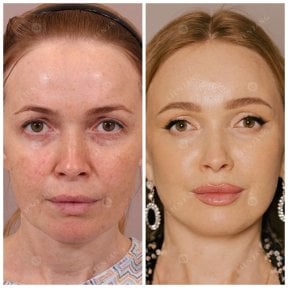 Before and after deep plane facelift results – facial rejuvenation and lifted contours
