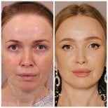 Before and after deep plane facelift results – facial rejuvenation and lifted contours