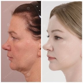Before and after deep plane facelift results at Lienjang Clinic – visible facial rejuvenation