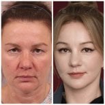 Before and after deep plane facelift results, visible facial rejuvenation and smoother skin