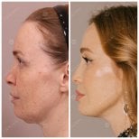 Before and after deep plane facelift results at Lienjang Clinic – visible facial rejuvenation