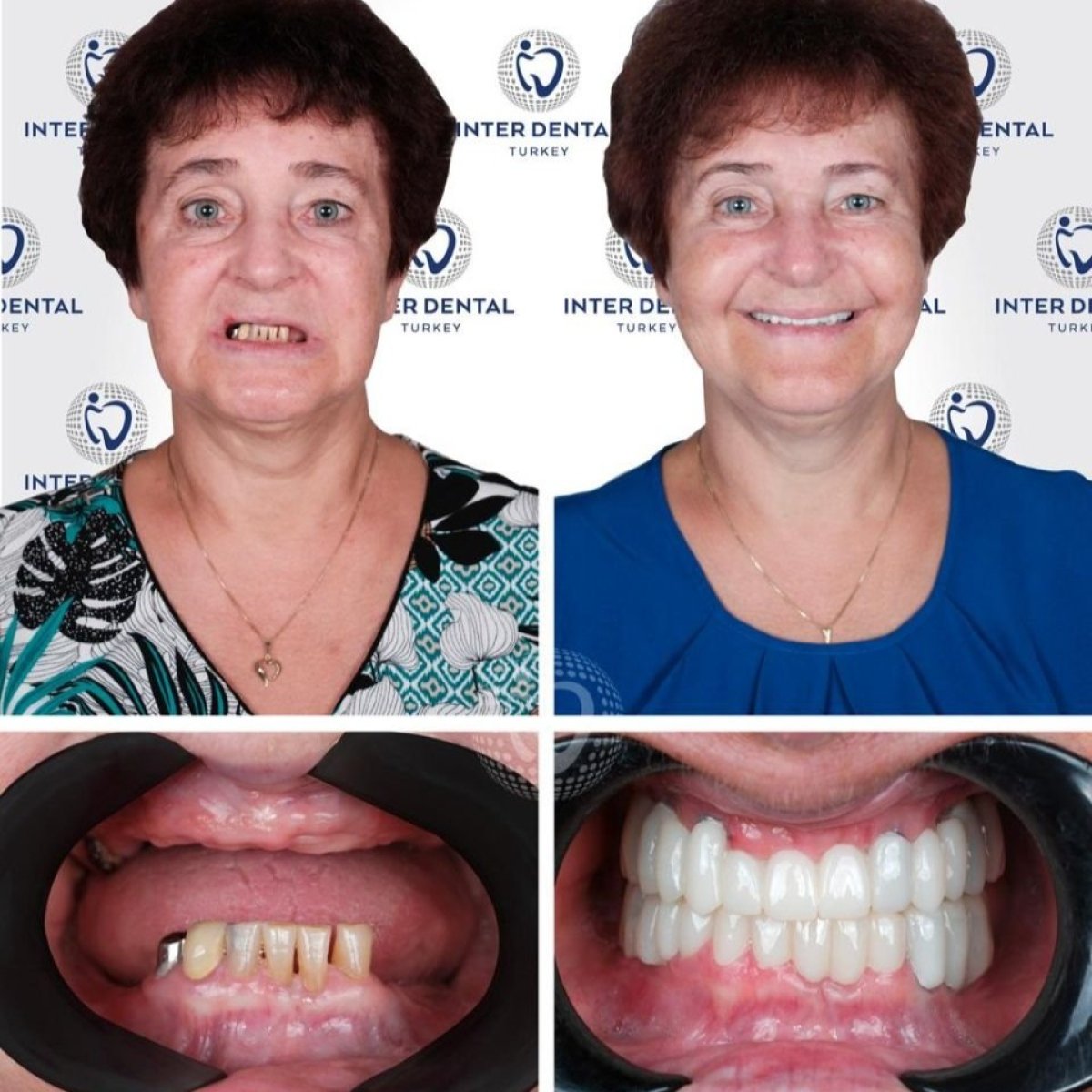 نتائج زراعة الأسنان قبل وبعد في Inter Dental Turkey، تحسين الابتسامة وترميم الأسنان