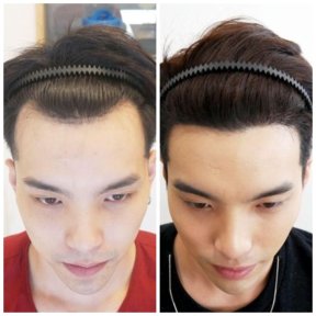 before-after photo fue-hair-transplant
