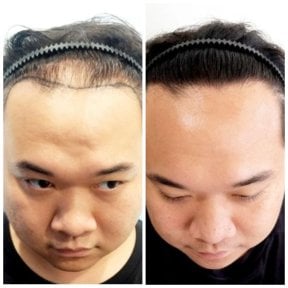 before-after photo fue-hair-transplant