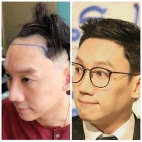 before-after photo fue-hair-transplant
