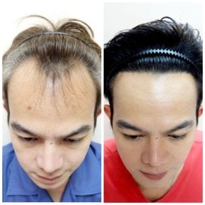 before-after photo fue-hair-transplant