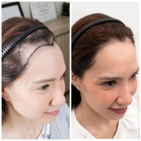 before-after photo fue-hair-transplant