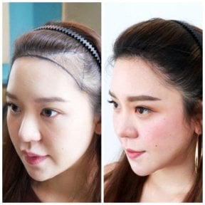 before-after photo fue-hair-transplant