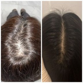 before-after photo fue-hair-transplant