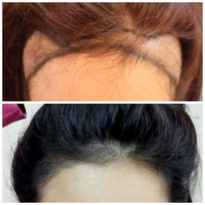 before-after photo fue-hair-transplant