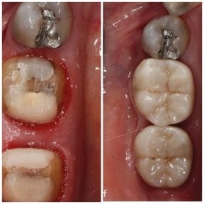 before-after photo implantacia-zuba